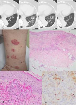 IgA vasculitis preceded by pulmonary hemorrhage in a patient with ulcerative colitis during treatment with vedolizumab